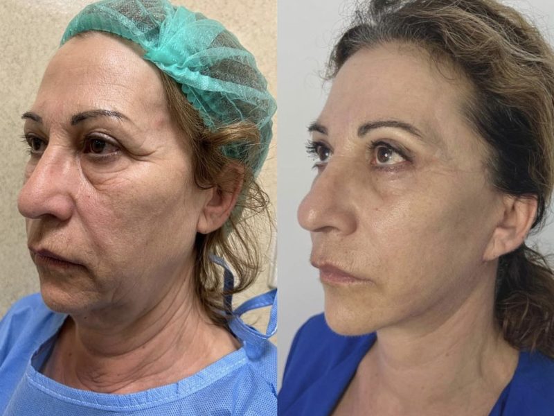 Massimiliano Leporati - Lifting - Chirurgia del volto