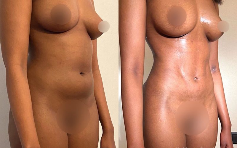 Massimiliano Leporati - Chirurgia del corpo - Liposcultura