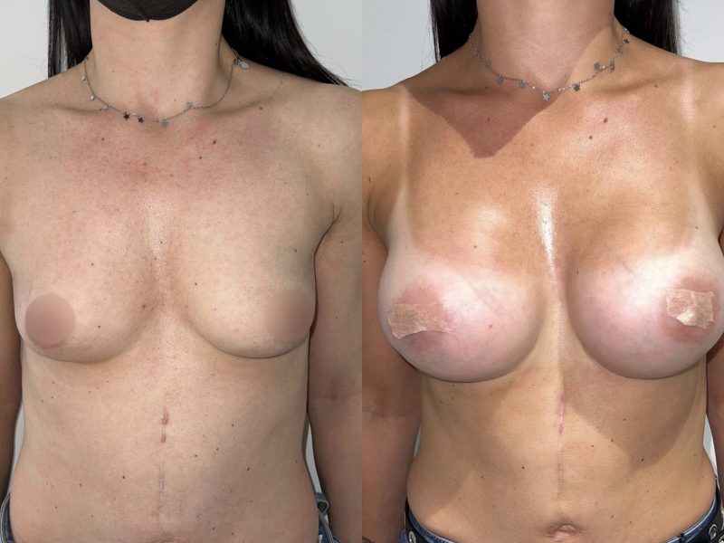 Massimiliano Leporati -Chirurgia del corpo - Mastoplastica additiva -